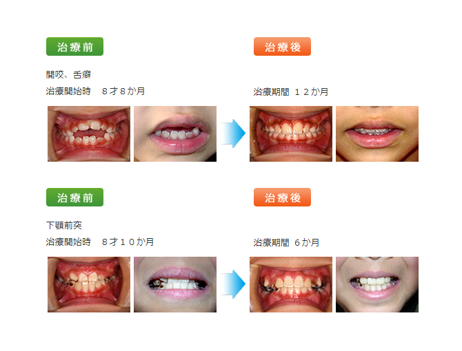矯正歯科治療「噛み合わせを変えず、1～2歯の部分的な歯科矯正」