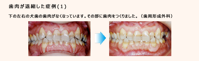 歯周病治療法